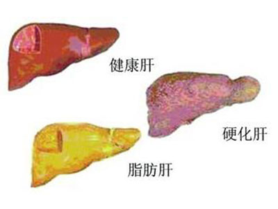 中度脂肪肝形成的原因