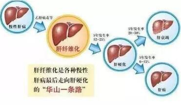 肝纤维化四项检查指标
