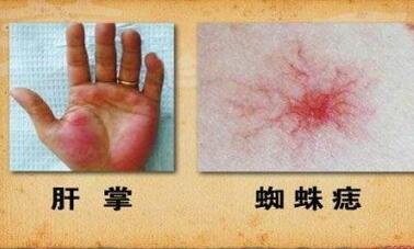 出现“三黄”症状 警惕肝炎