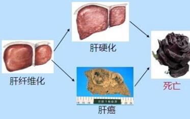 肝纤维化的危害有哪些